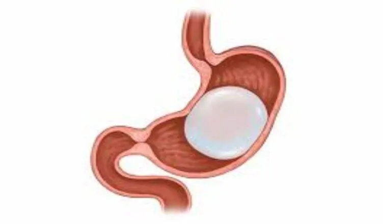 gastric balloon placement in Dubai
