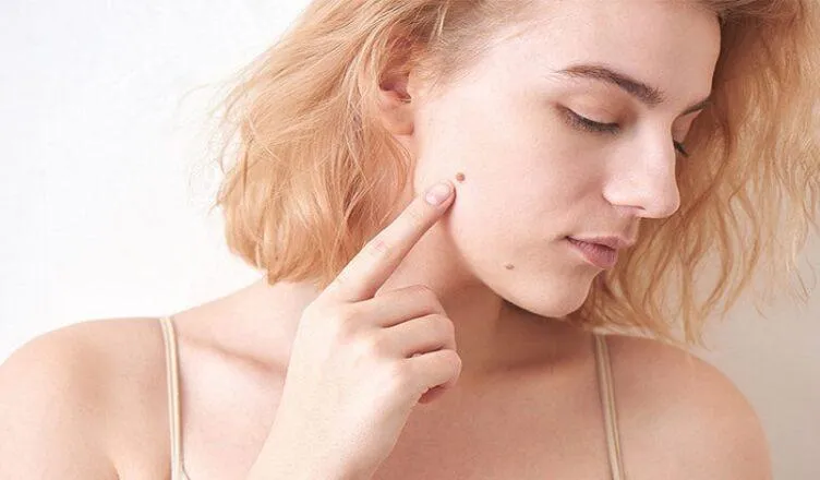 mole removal in dubai