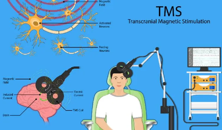 TMS Therapy for Depression